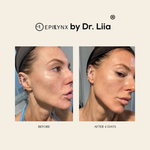 Load image into Gallery viewer, EpiLynx - Pore Refining Serum - Acne Scars and Redness Relief
